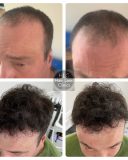 Hair Replacement systems1