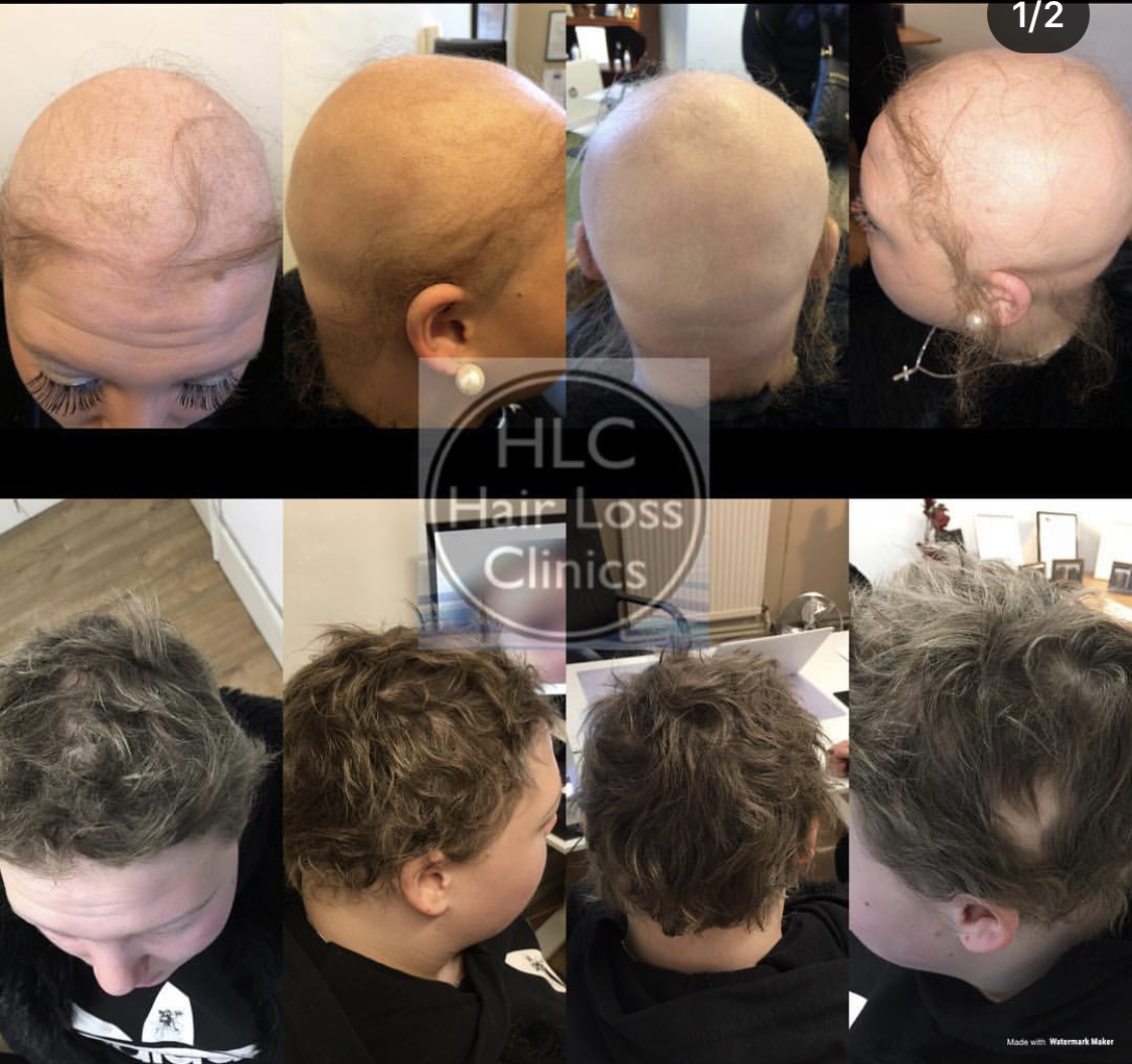 Alopecia & Treatments Hair Loss Specialist Clinic
