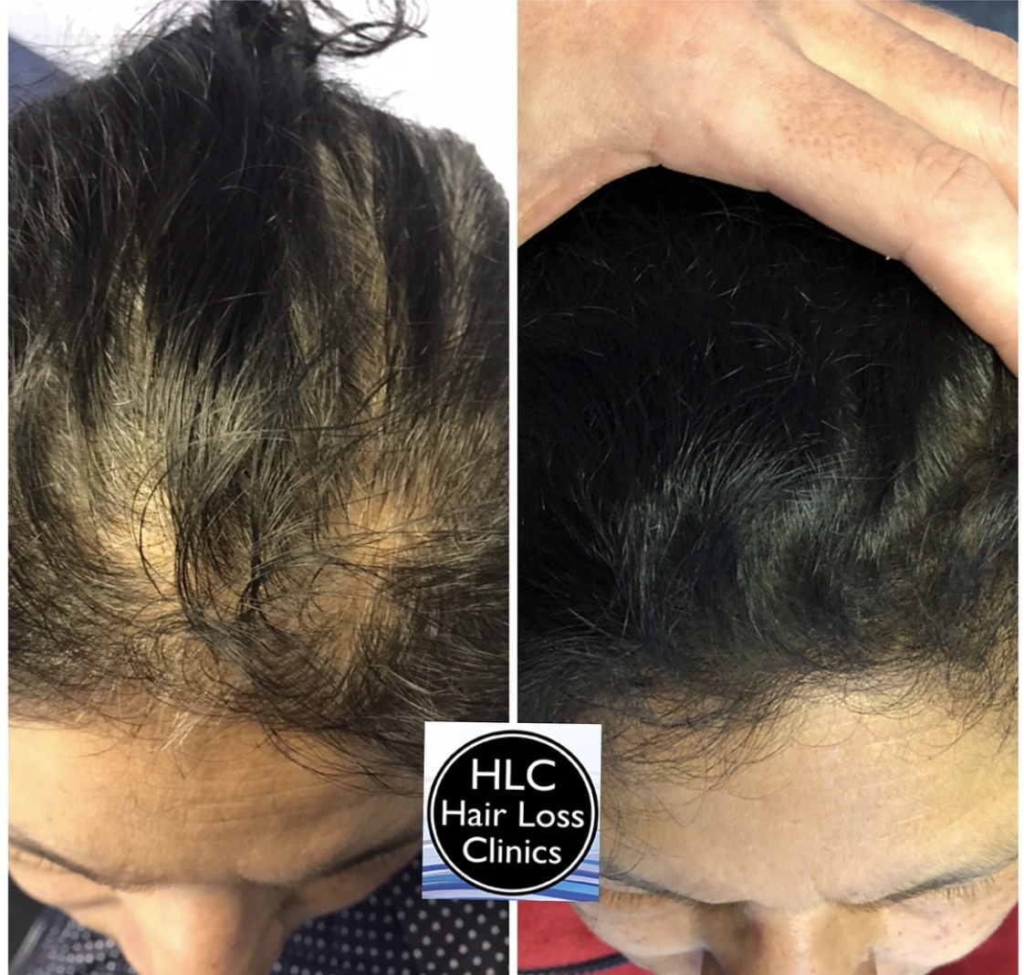 Hair Fall Treatment in Lahore - Aestheticare - Hair loose Clinic