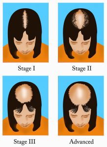 hair loss stages