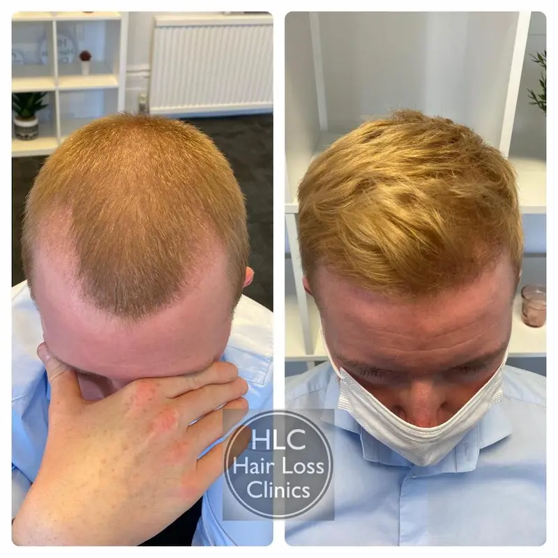 Hair Loss Clinic - Warrington in Ribbleton, Preston