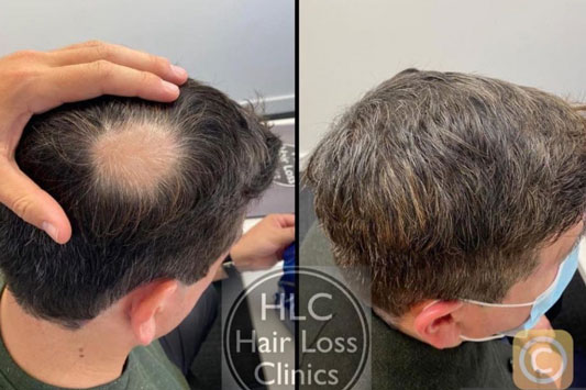 Alopecia & Other Hair Loss Conditions