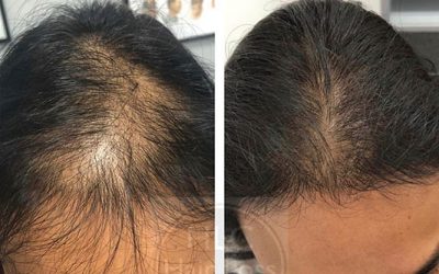 HLC Laser Hair Therapy