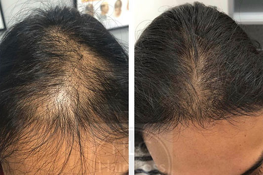 HLC Laser Hair Therapy