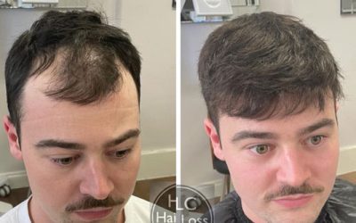 HLC Hair Transplants