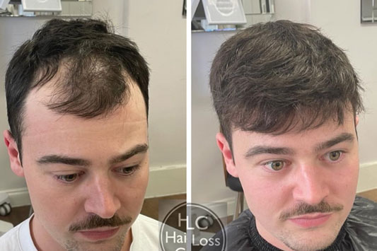 HLC Hair Transplants