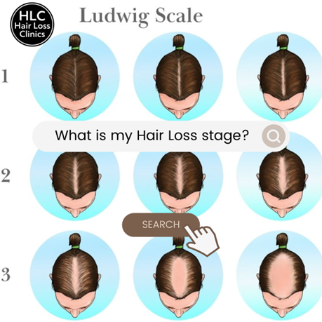 Facts About Pattern Hair Loss