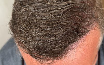 Hormones and Hair Loss