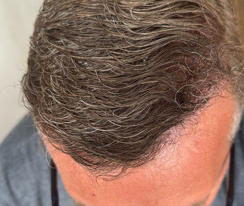 Hormones and Hair Loss