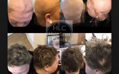 Understanding Alopecia – HLC