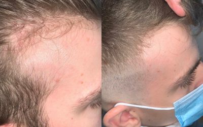 Minoxidil or Laser Hair Therapy?